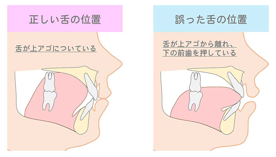 成田市公津の杜の歯医者。はばたき矯正・こども歯科で小児矯正