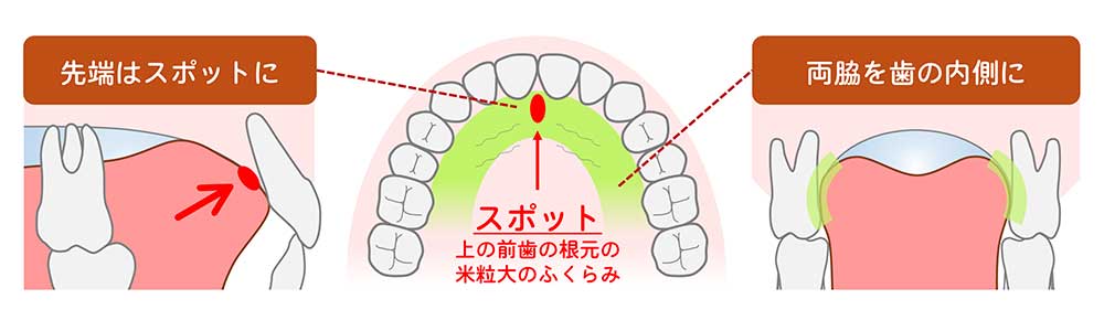 成田市公津の杜の歯医者。はばたき矯正・こども歯科で小児矯正