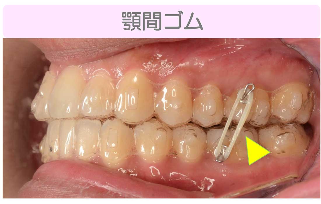 成田市公津の杜の歯医者、はばたき矯正・こども歯科のマウスピース矯正