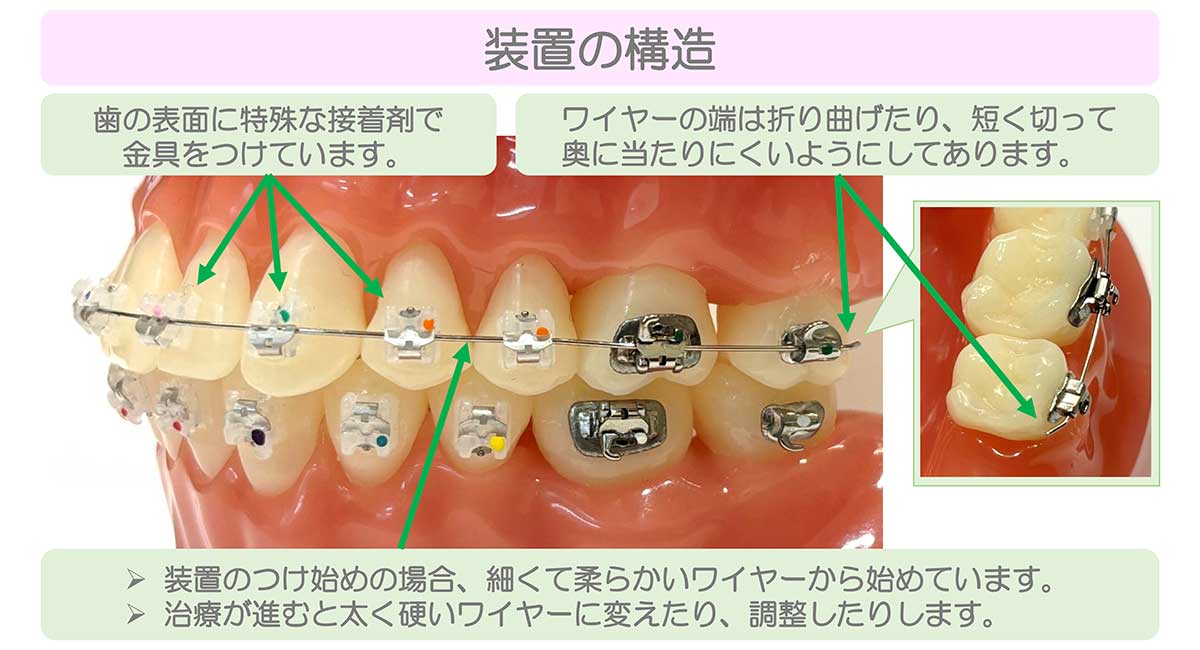 成田市公津の杜の歯医者、はばたき矯正・こども歯科のワイヤー矯正の説明