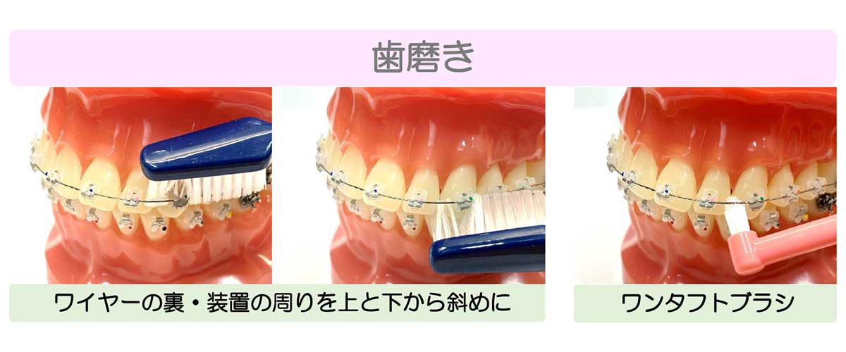 成田市公津の杜の歯医者、はばたき矯正・こども歯科のワイヤー矯正の説明