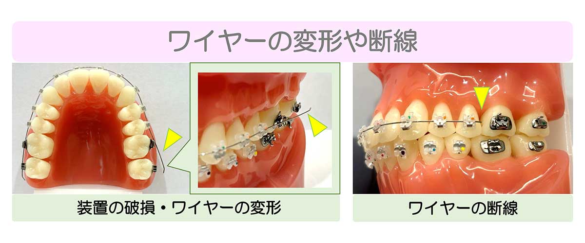 成田市公津の杜の歯医者、はばたき矯正・こども歯科のワイヤー矯正の説明