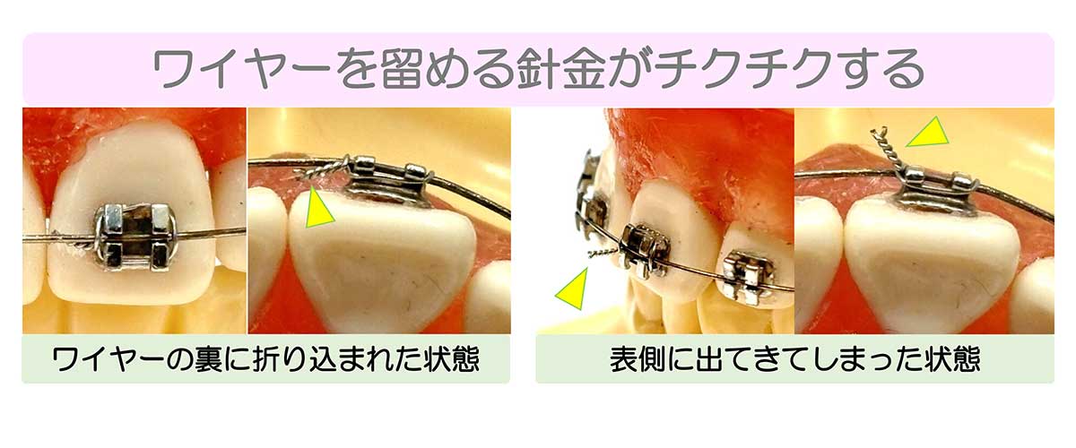 成田市公津の杜の歯医者、はばたき矯正・こども歯科のワイヤー矯正の説明