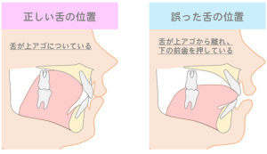成田市公津の杜の歯医者、はばたき矯正・こども歯科の舌癖についての解説