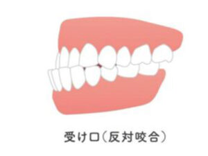 成田市公津の杜の歯医者、はばたき矯正・こども歯科の舌癖についての解説