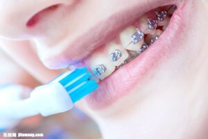 成田市公津の杜の歯医者、はばたき矯正・こども歯科で、矯正中にむし歯になるとどうなるの？について解説