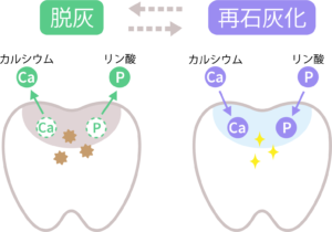 成田市公津の杜の歯医者、はばたき矯正・こども歯科で、矯正中に気をつけたい「白いまだら模様」―ブラケット周囲の初期脱灰とは？