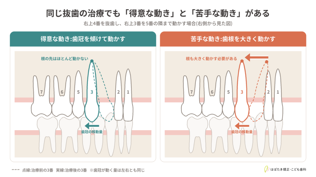 上の犬歯を後ろへ動かす2つのケースの比較図。根が後ろに傾いている場合は歯を傾けるだけで動かせるが、根が前に傾いている場合は骨の中に埋まっている根を大きく動かす必要がある
