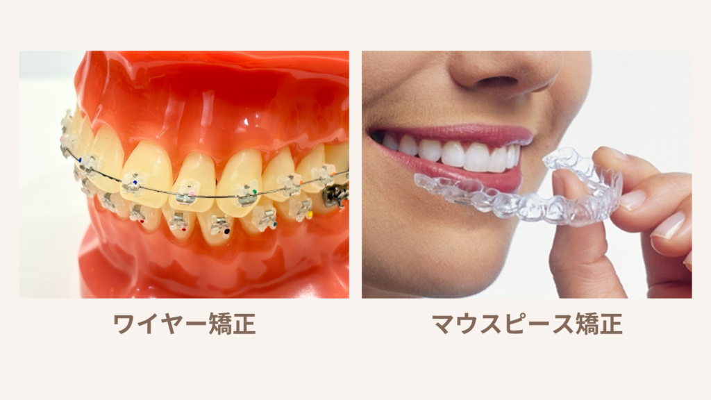 ワイヤー矯正の装置(歯に付けたブラケットとワイヤー)と、透明なマウスピース型矯正装置の比較写真