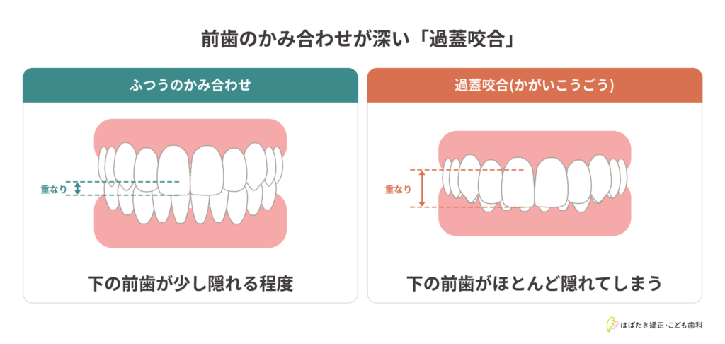 ふつうのかみ合わせと過蓋咬合を正面から比べた図。過蓋咬合では上の前歯が下の前歯をほとんど覆い隠している